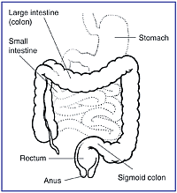 crohn , crohn's disease