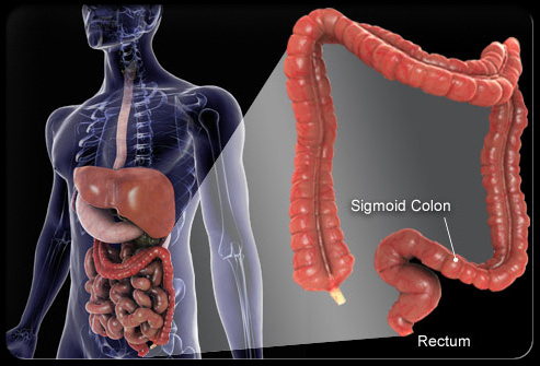 colorectal cancer