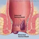 hemorrhoids